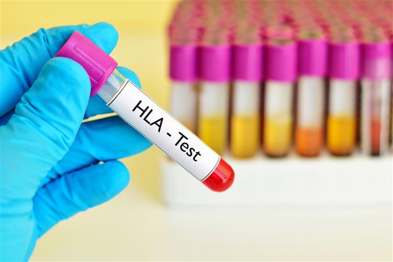 Diagram illustrating HLA markers and the matching process used in stem cell transplantation